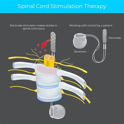 SCS placement surgery is done in 2 stages. . Spinal cord stimulator permanent restrictions